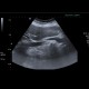 Acute cholecystitis: US - Ultrasound